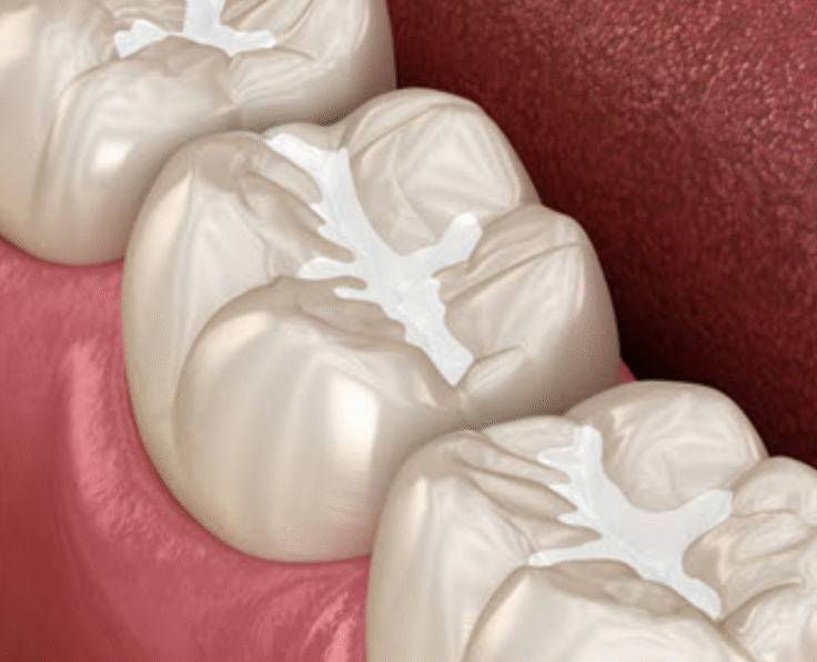 Sealants & Fluoride Treatments banner