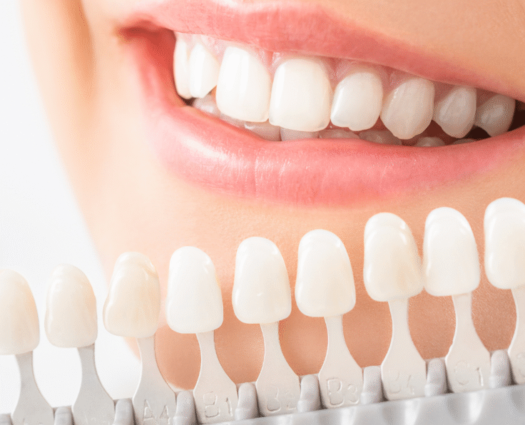 Teeth Whitening (Bleaching)banner
