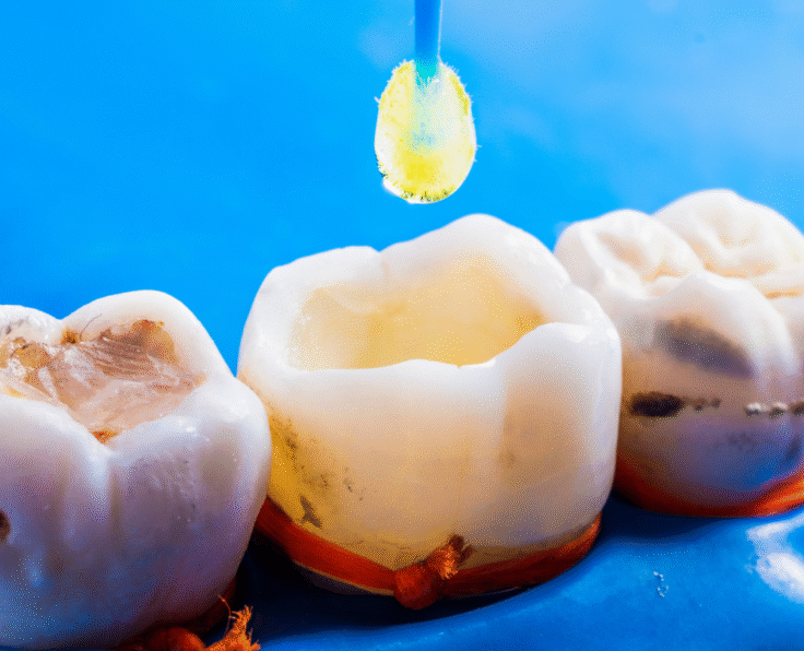 Tooth-Colored Fillings banner